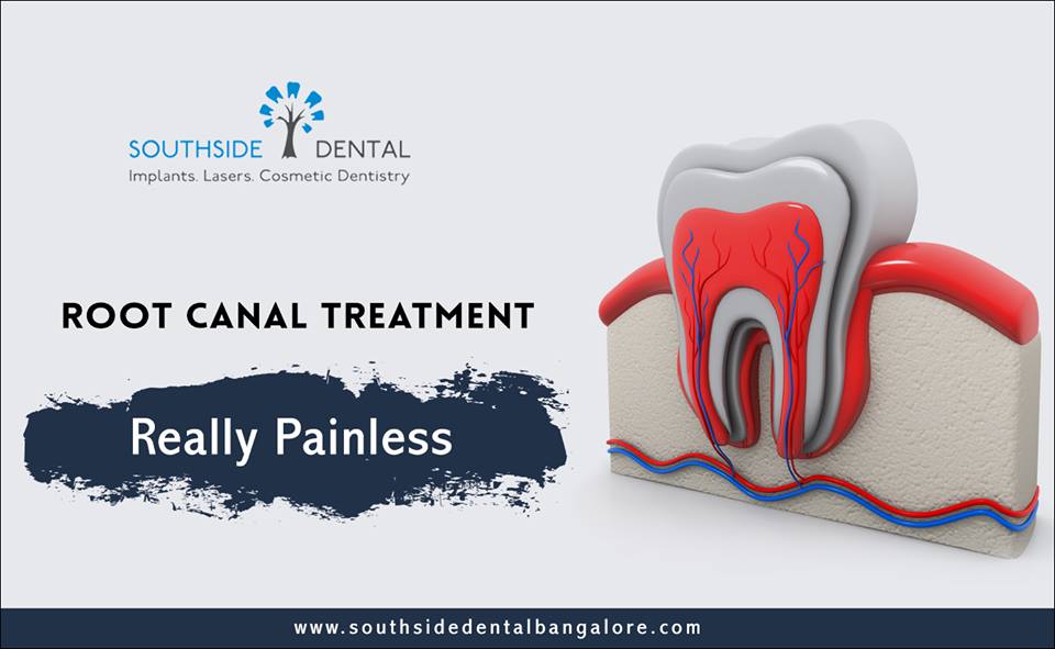 root-canal-treatment-in-bangalore