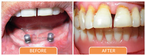 Implant supported dentures bangalore, karnataka, india
