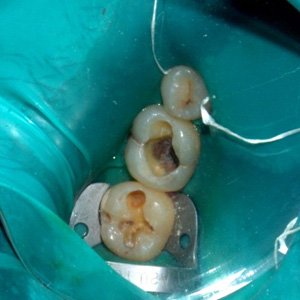 decayed teeth reatment