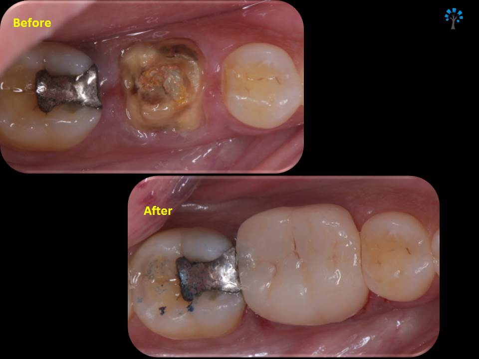 Before and After