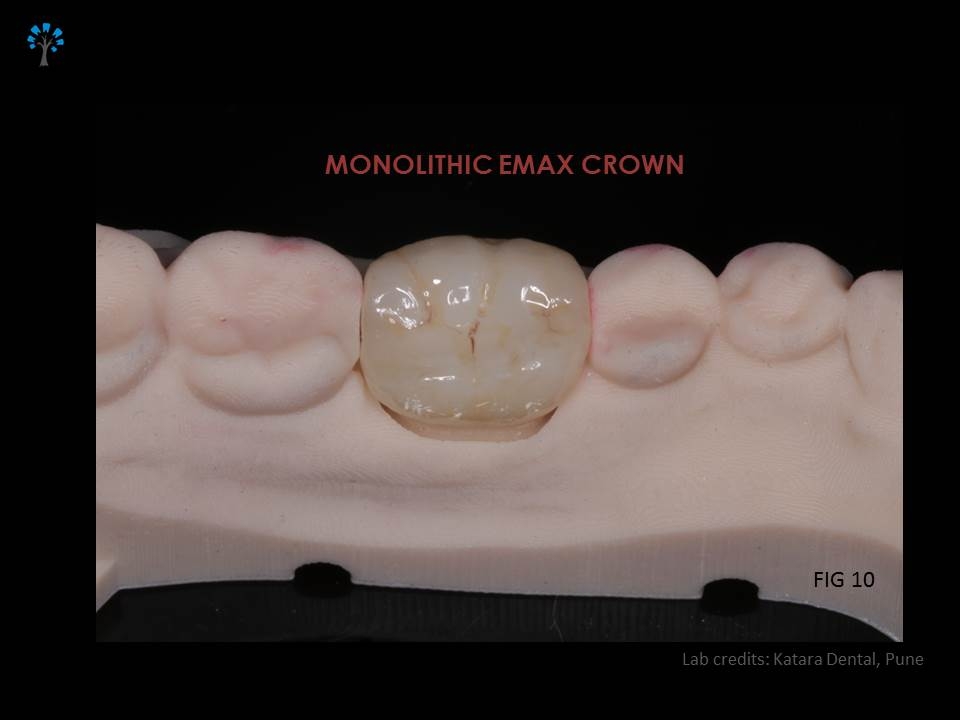 EMAX Crown , KATARA DENTAL PUNE