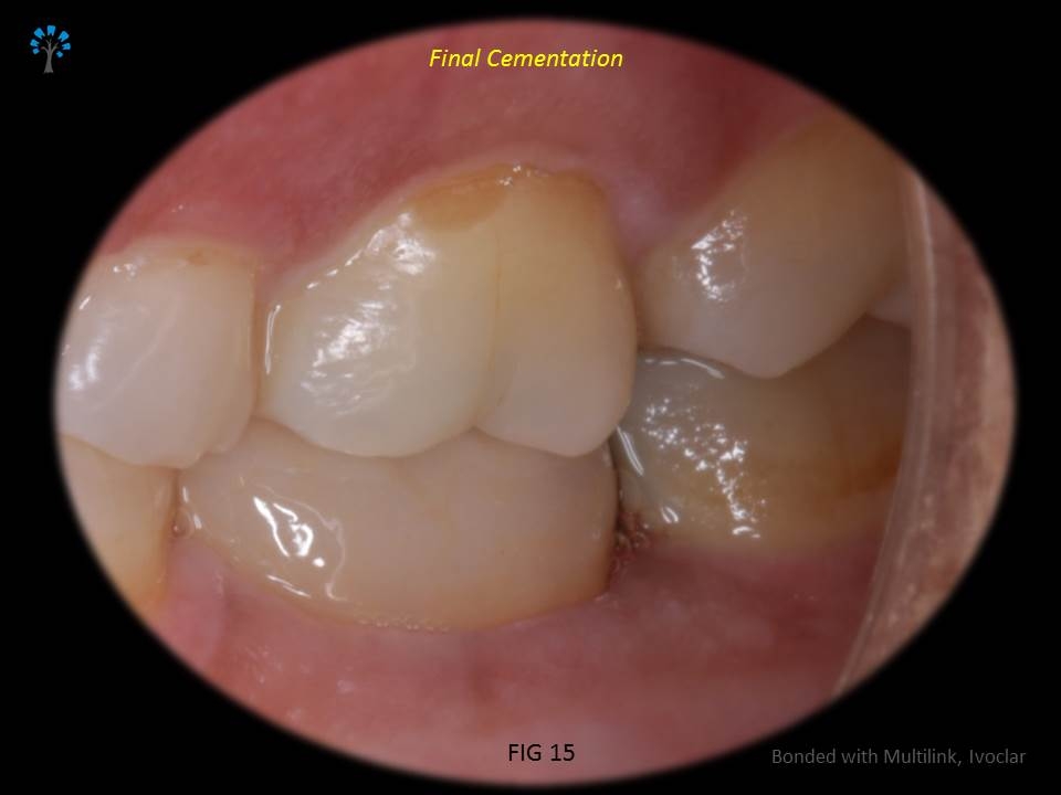 EMX Crown in Occlusion
