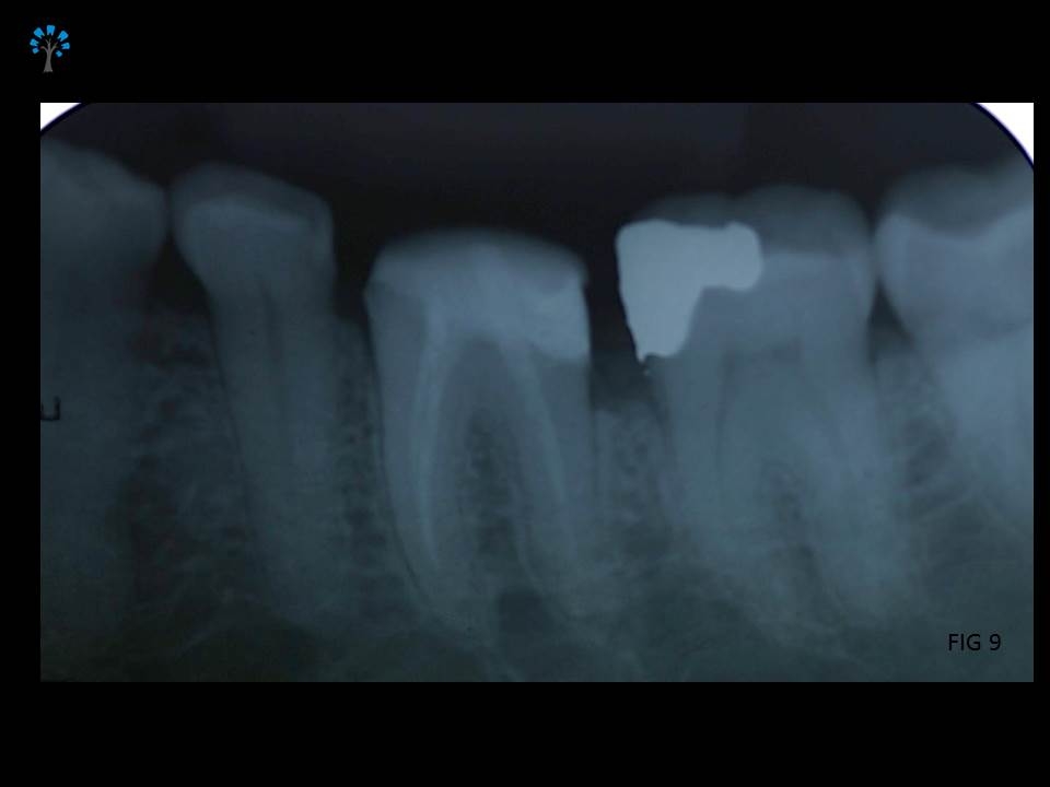 IOPA Radiograph after post and core build up.