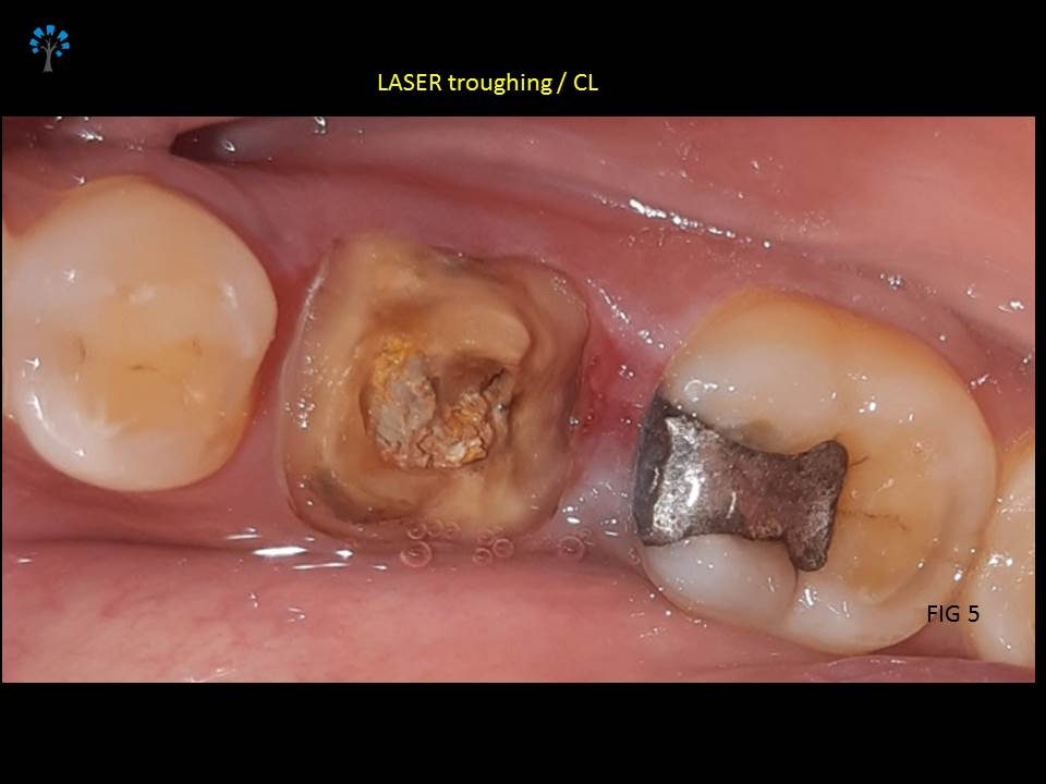 Post operative view after Crown legthening with LASER 