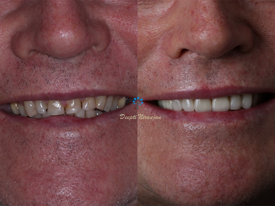 Before and after smile view