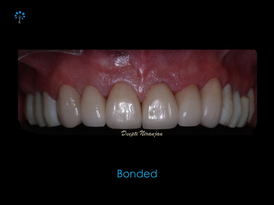 Crowns and veneers bonded