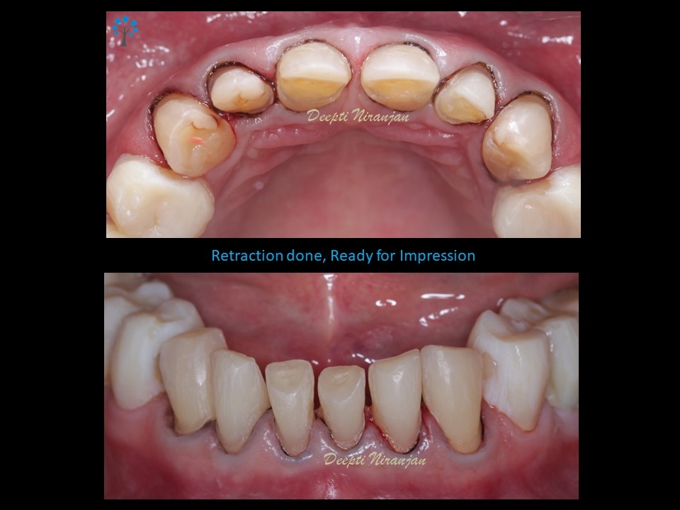 Teeth prepared for impression