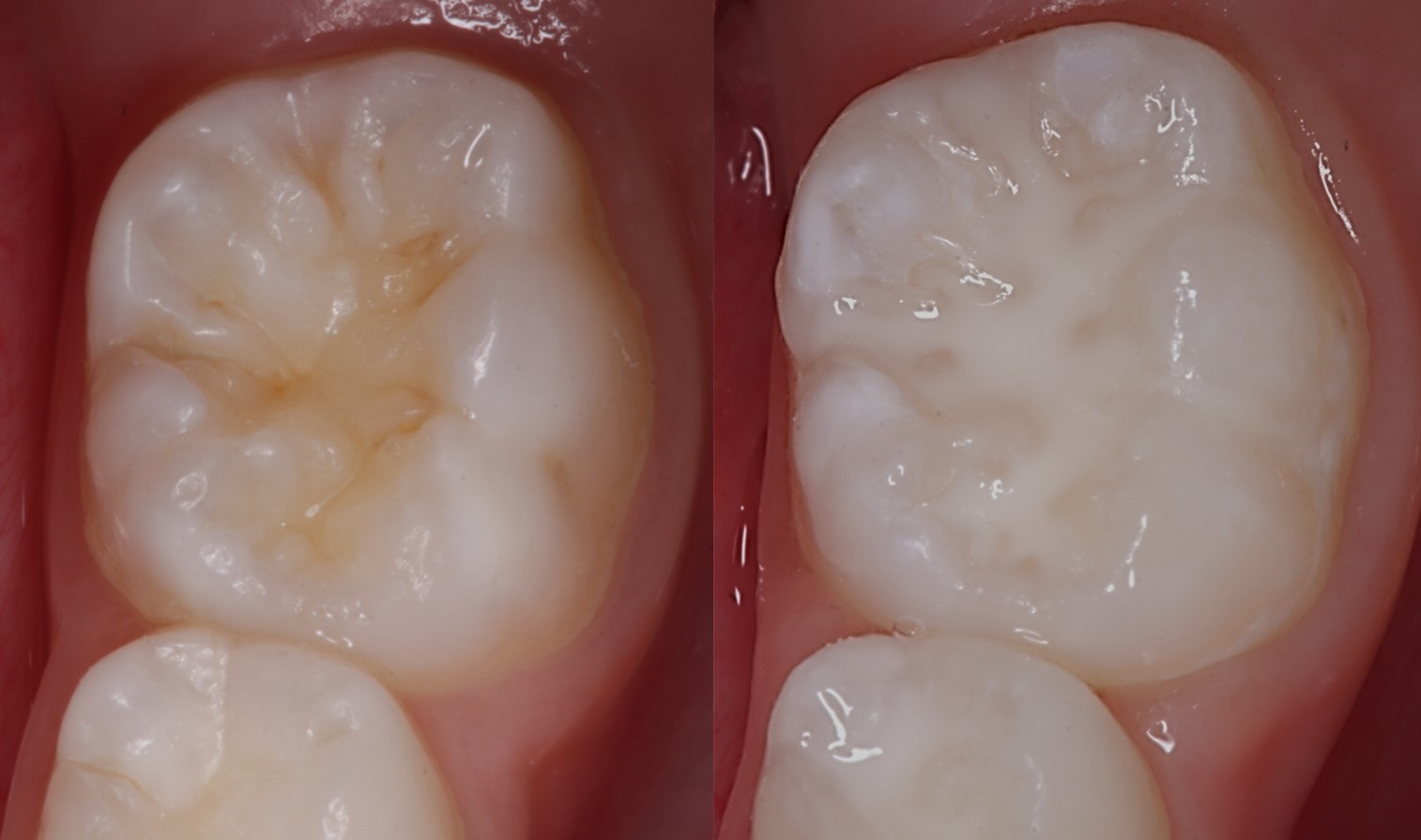 Pit and fissure sealants