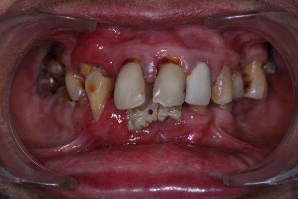 imageuploads/covered/2024/03/26/enhance-your-smile-and-comfort-with-implant-supported-overdentures.jpg