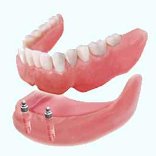 Implant Supported over dentures