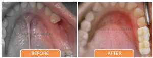 multiple teeth replacement bangalore, karnataka, india