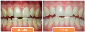 teeth whitening procedure bangalore, karnataka, india