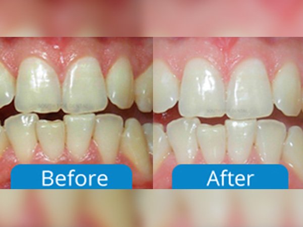 before after dental treatment bangalore