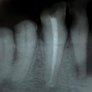root canal treatment rct